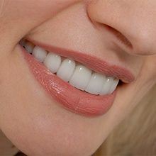close shot of smile with direct bonding