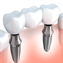 illustration of multiple implants